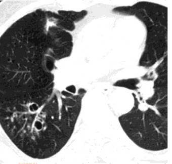 胸部CT常见征象详解|树芽征