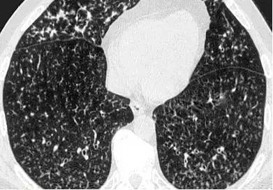 胸部CT常见征象详解|树芽征