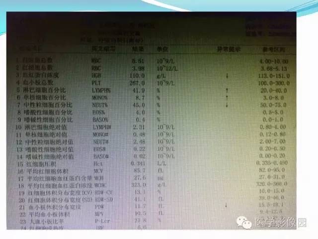 【病例】肺叶实变性支气管肺泡癌1例CT影像表现