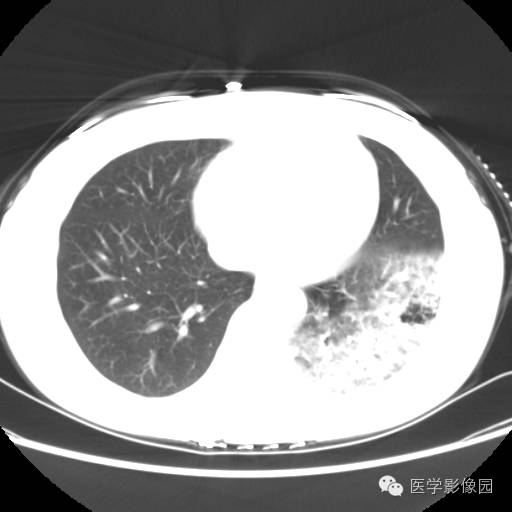 【病例】肺叶实变性支气管肺泡癌1例CT影像表现