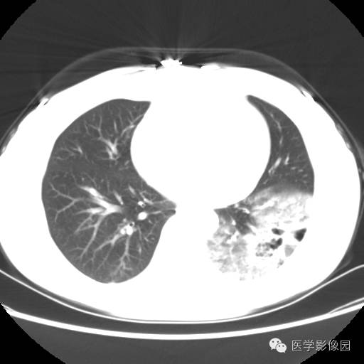 【病例】肺叶实变性支气管肺泡癌1例CT影像表现
