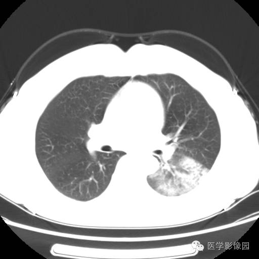 【病例】肺叶实变性支气管肺泡癌1例CT影像表现