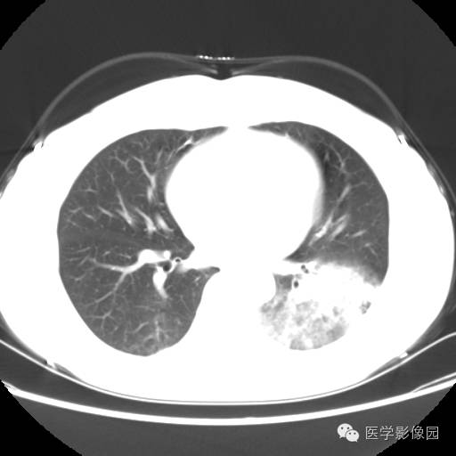 【病例】肺叶实变性支气管肺泡癌1例CT影像表现