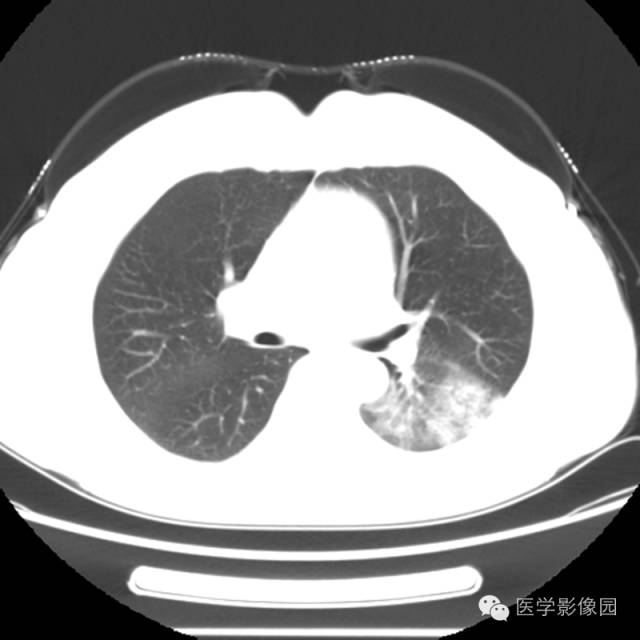【病例】肺叶实变性支气管肺泡癌1例CT影像表现
