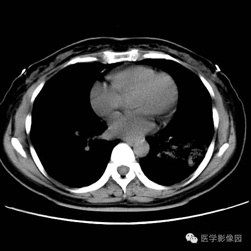 【病例】肺叶实变性支气管肺泡癌1例CT影像表现