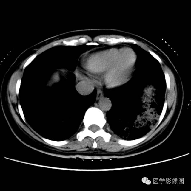 【病例】肺叶实变性支气管肺泡癌1例CT影像表现