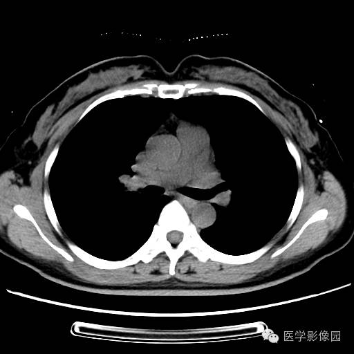 【病例】肺叶实变性支气管肺泡癌1例CT影像表现