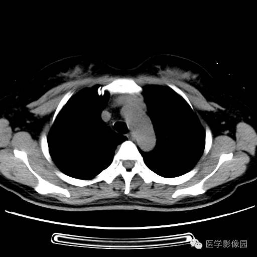 【病例】肺叶实变性支气管肺泡癌1例CT影像表现