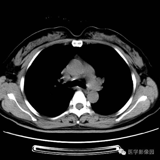 【病例】肺叶实变性支气管肺泡癌1例CT影像表现