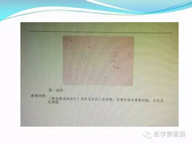 【病例】肺叶实变性支气管肺泡癌1例CT影像表现