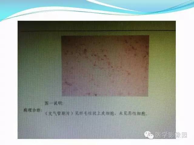 【病例】肺叶实变性支气管肺泡癌1例CT影像表现