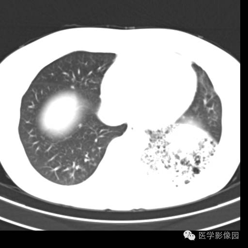 【病例】肺叶实变性支气管肺泡癌1例CT影像表现