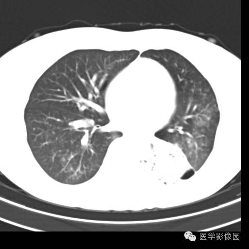 【病例】肺叶实变性支气管肺泡癌1例CT影像表现