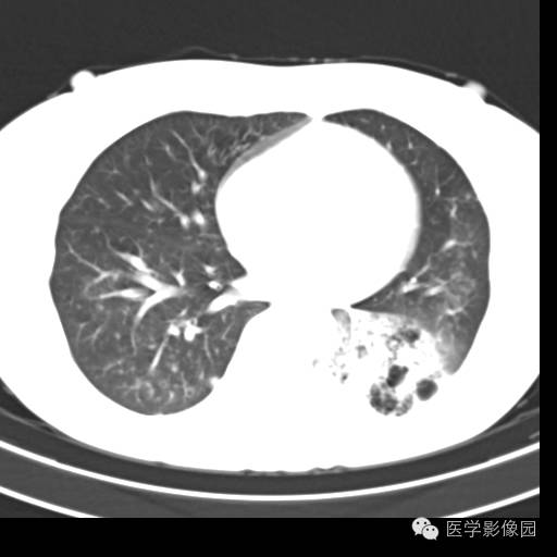 【病例】肺叶实变性支气管肺泡癌1例CT影像表现