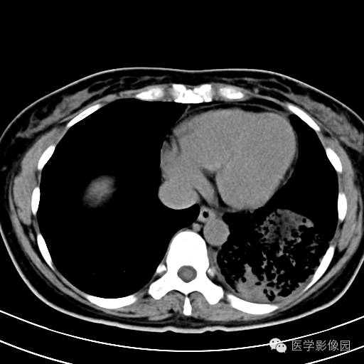 【病例】肺叶实变性支气管肺泡癌1例CT影像表现