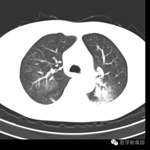 【病例】肺叶实变性支气管肺泡癌1例CT影像表现