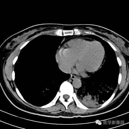 【病例】肺叶实变性支气管肺泡癌1例CT影像表现