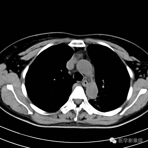 【病例】肺叶实变性支气管肺泡癌1例CT影像表现