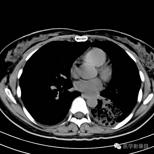 【病例】肺叶实变性支气管肺泡癌1例CT影像表现