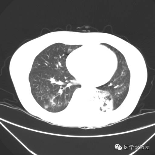 【病例】肺叶实变性支气管肺泡癌1例CT影像表现