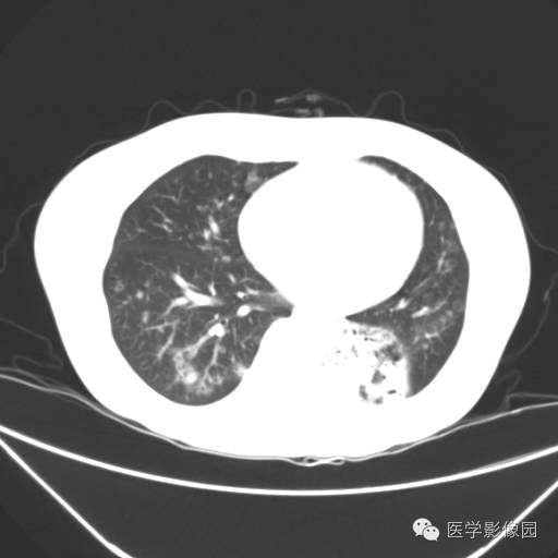 【病例】肺叶实变性支气管肺泡癌1例CT影像表现