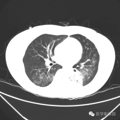 【病例】肺叶实变性支气管肺泡癌1例CT影像表现