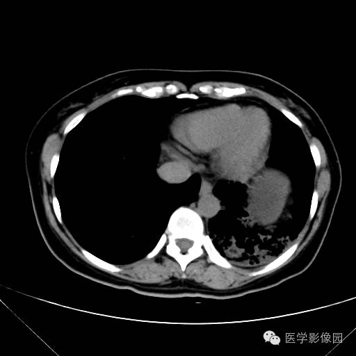 【病例】肺叶实变性支气管肺泡癌1例CT影像表现