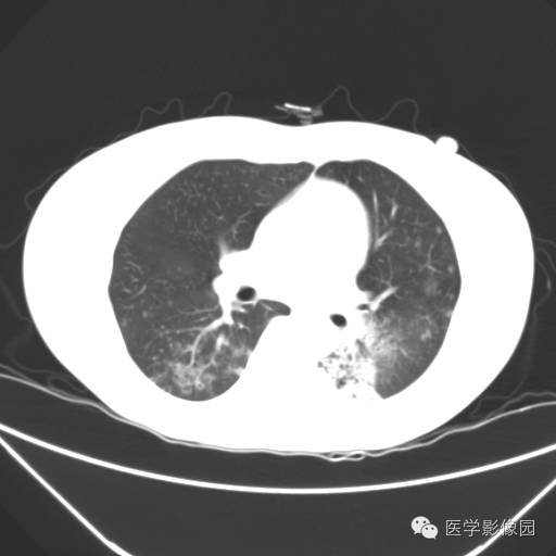 【病例】肺叶实变性支气管肺泡癌1例CT影像表现