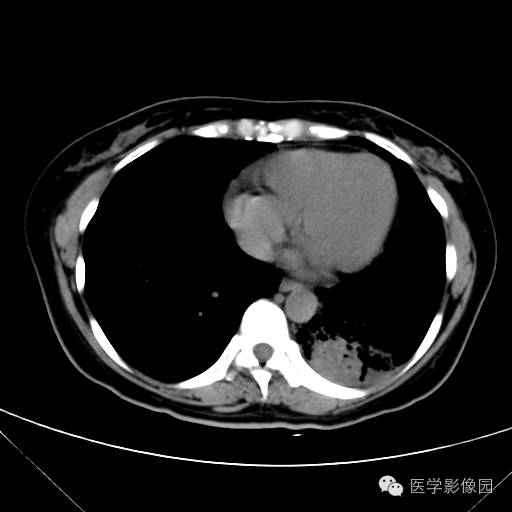【病例】肺叶实变性支气管肺泡癌1例CT影像表现
