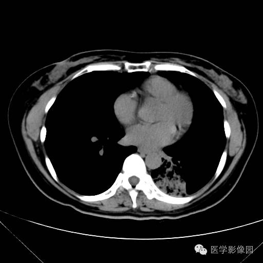 【病例】肺叶实变性支气管肺泡癌1例CT影像表现