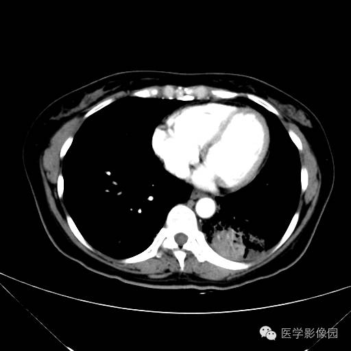 【病例】肺叶实变性支气管肺泡癌1例CT影像表现
