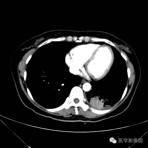 【病例】肺叶实变性支气管肺泡癌1例CT影像表现