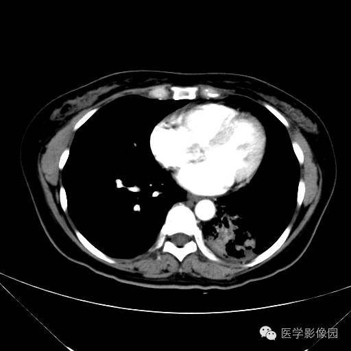 【病例】肺叶实变性支气管肺泡癌1例CT影像表现