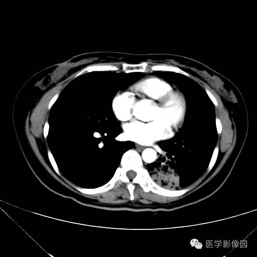 【病例】肺叶实变性支气管肺泡癌1例CT影像表现