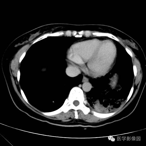 【病例】肺叶实变性支气管肺泡癌1例CT影像表现