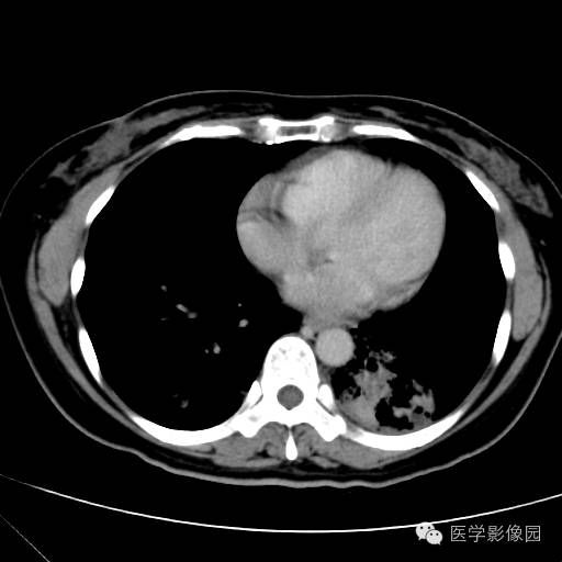 【病例】肺叶实变性支气管肺泡癌1例CT影像表现