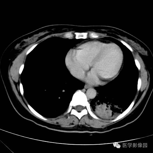 【病例】肺叶实变性支气管肺泡癌1例CT影像表现