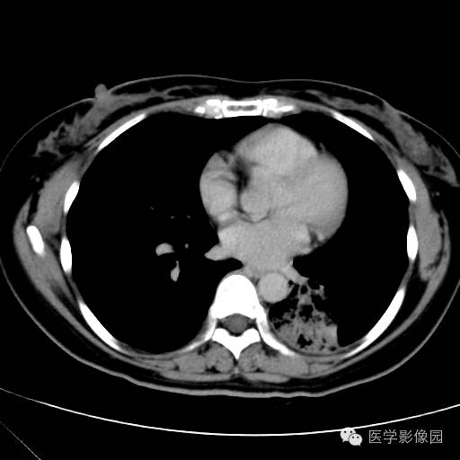 【病例】肺叶实变性支气管肺泡癌1例CT影像表现