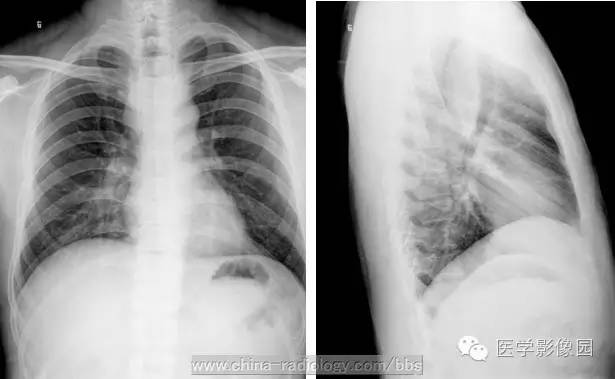 最常见的食管良性肿瘤是什么？ ——食管平滑肌瘤
