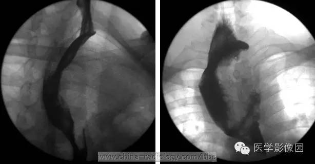 最常见的食管良性肿瘤是什么？ ——食管平滑肌瘤