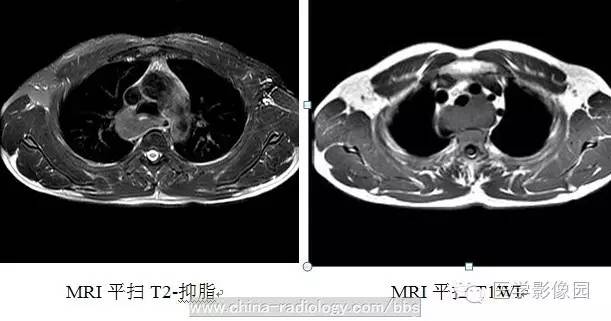 最常见的食管良性肿瘤是什么？ ——食管平滑肌瘤
