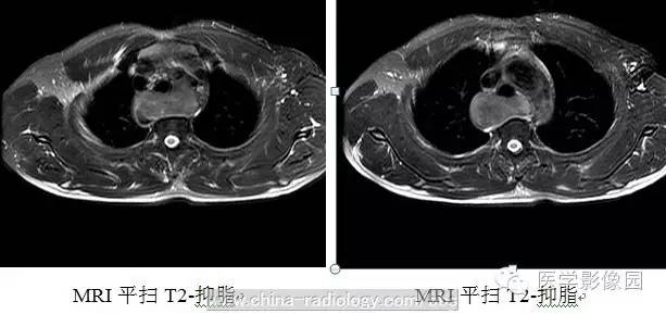 最常见的食管良性肿瘤是什么？ ——食管平滑肌瘤