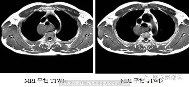 最常见的食管良性肿瘤是什么？ ——食管平滑肌瘤