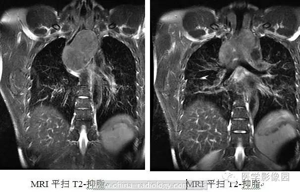 最常见的食管良性肿瘤是什么？ ——食管平滑肌瘤