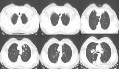 肺平滑肌瘤一例CT影像表现
