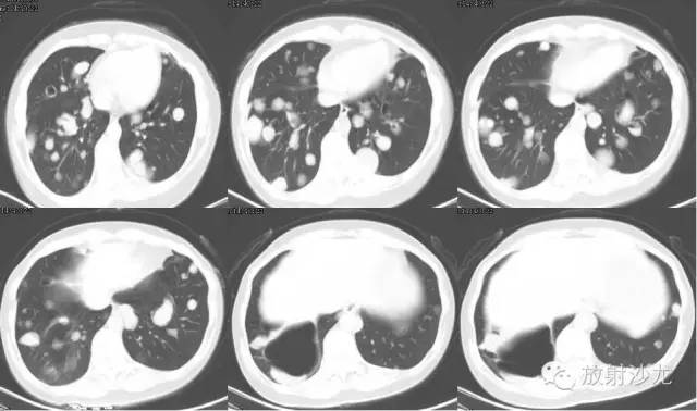 【病例】肺平滑肌瘤一例CT影像表现