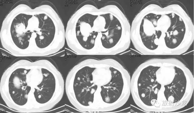【病例】肺平滑肌瘤一例CT影像表现