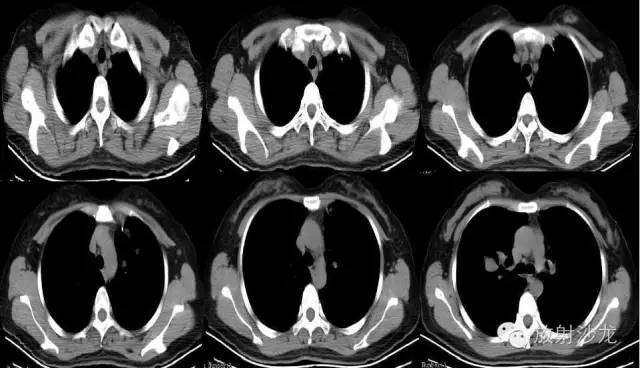 【病例】肺平滑肌瘤一例CT影像表现