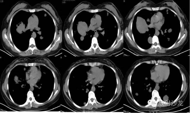 【病例】肺平滑肌瘤一例CT影像表现