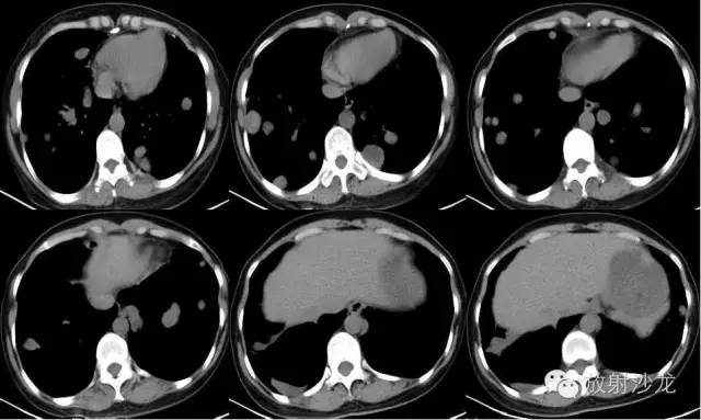 【病例】肺平滑肌瘤一例CT影像表现